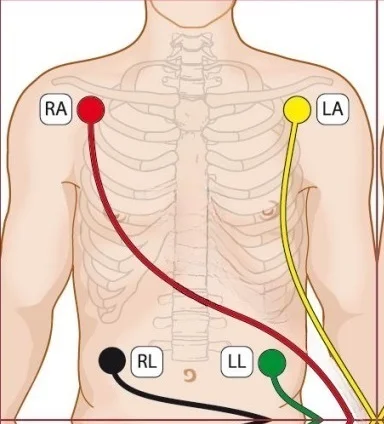 ads1192-ecg-connection